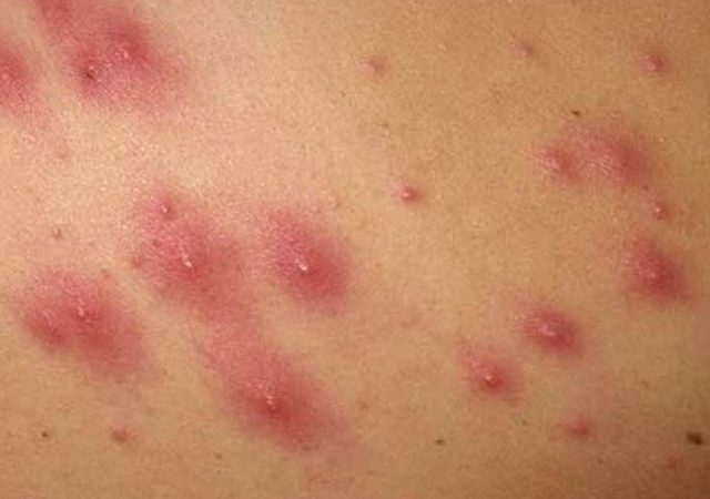 Как предотвратить инфекции стафилококка на коже