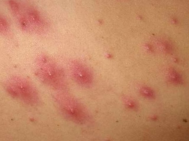 Как предотвратить инфекции стафилококка на коже